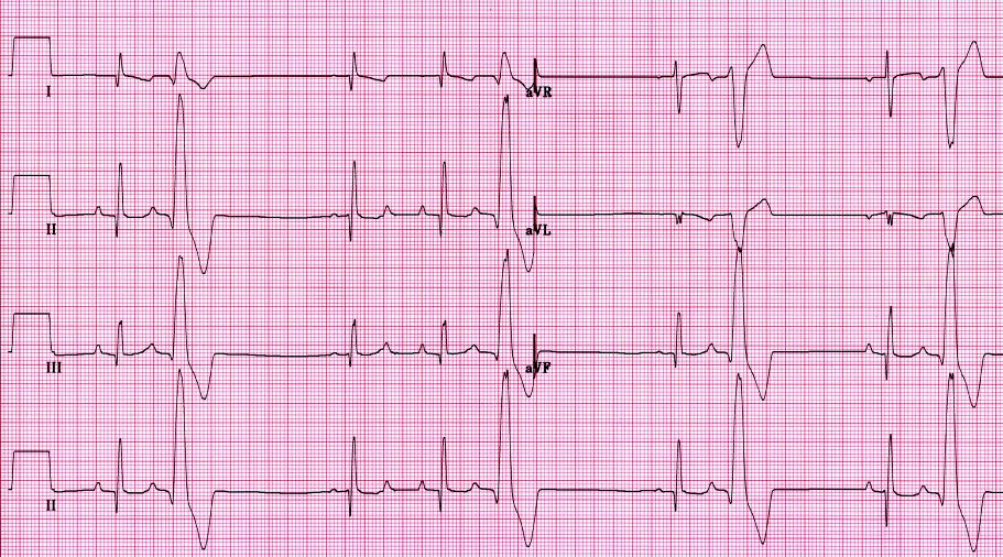 EKG Seminar Bw