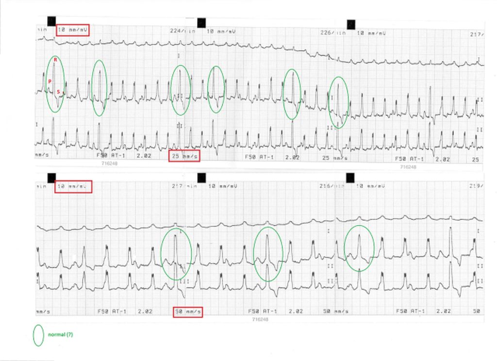 EKG