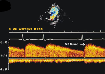 CW Doppler image in PDA