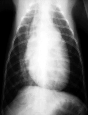 DV thoracic radiograph of a dog with PDA